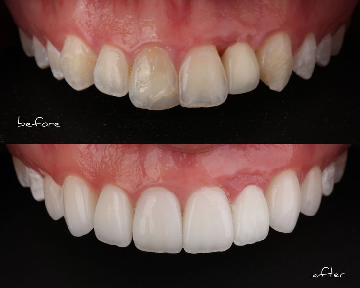 Veneer final result